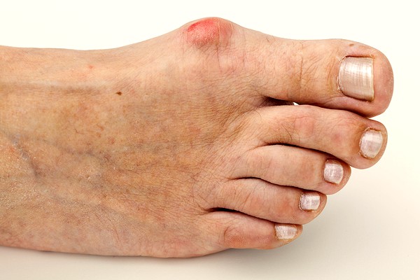 Can you have a bunion deformity and still have a straight toe? -  Orthopaedics 360
