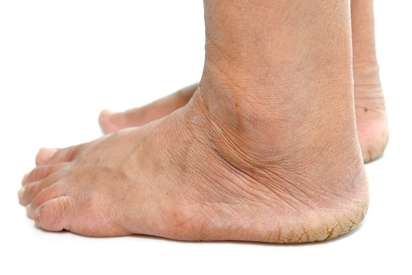 Diabetes Foot Treatment Alberta