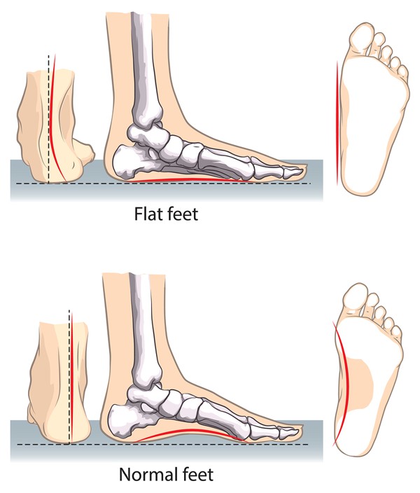 Flat Feet Treatment alberta Treatment Alberta