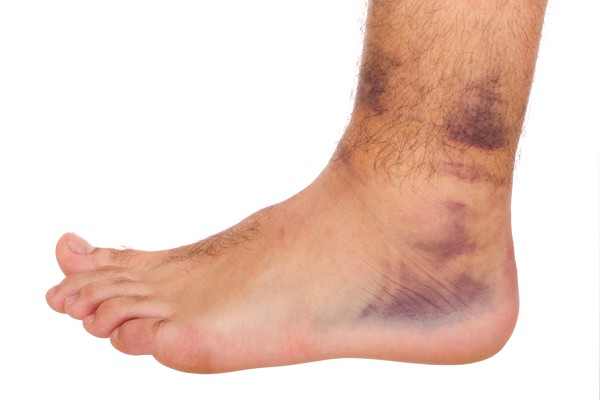 Ankle Instability & Ankle Sprains, JD Cowen Foot Clinic